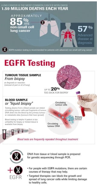 new blood testing technology, liquid biopsy, is used for tracking EGFR mutations in lung cancer cases