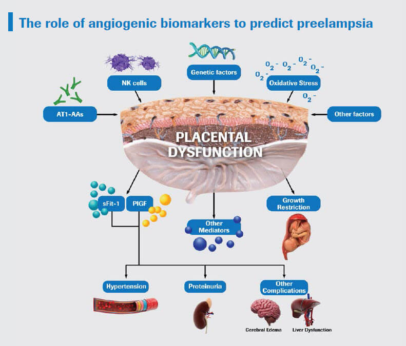 The role of angiogenic biomarkers in predicting preeclampsia