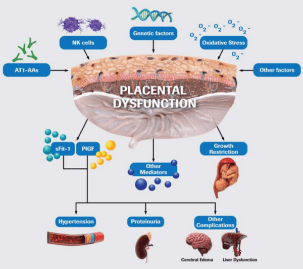 The role of angiogenic biomarkers in predicting preeclampsia
